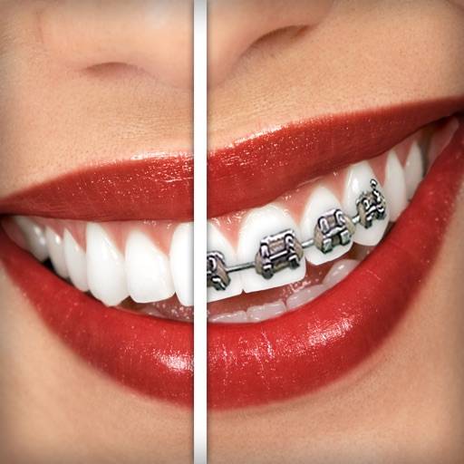 elimina Apparecchio ai denti